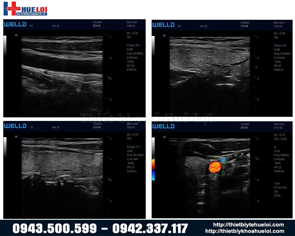 Chất lượng hình ảnh máy siêu âm khớp xách tay p10