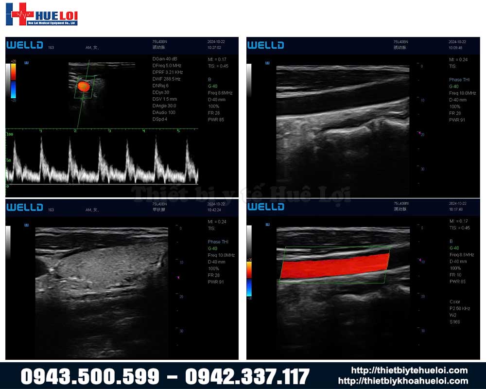 Chất lượng hình ảnh máy siêu âm hình ảnh không dây