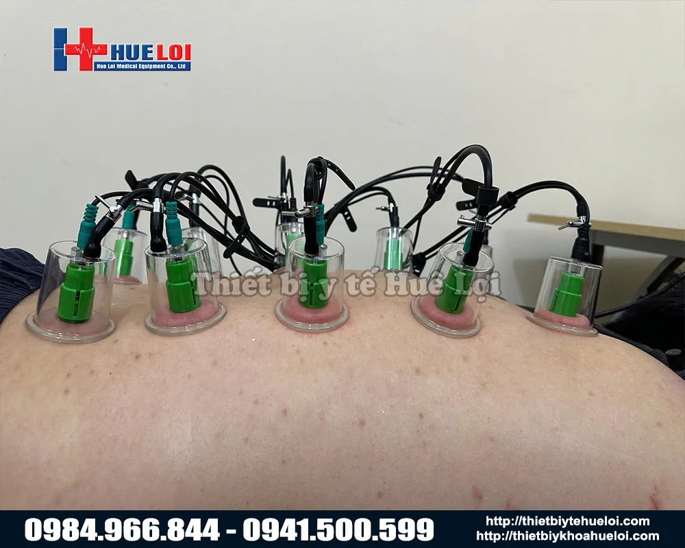 Cốc điện châm giác hút máy điện châm không xâm lấn