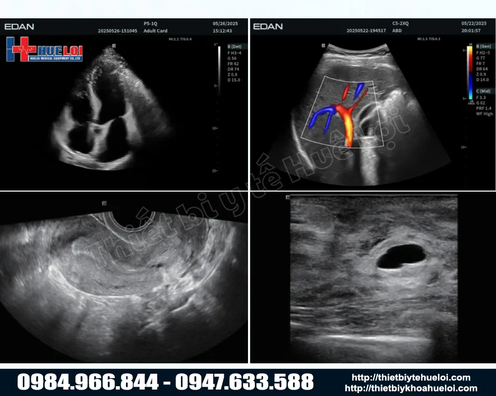 Công nghệ EDAN Synsight của máy siêu âm bàn đẩy edan lx85