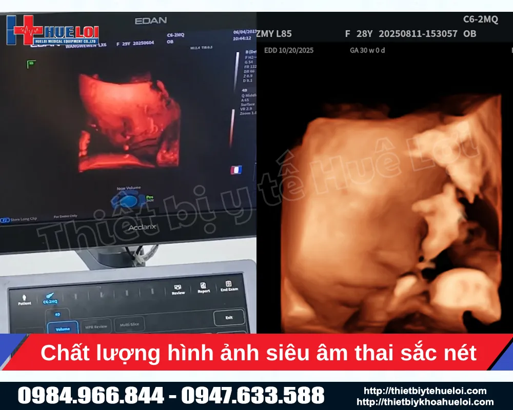 Công nghệ e- live của máy siêu âm 5D của máy siêu âm bàn đẩy edan lx85