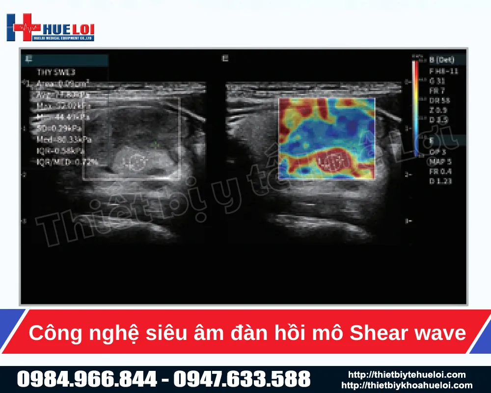 Công nghệ siêu âm đàn hồi mô Shear wave tích hợp trong máy siêu âm chẩn đoán hiện đại