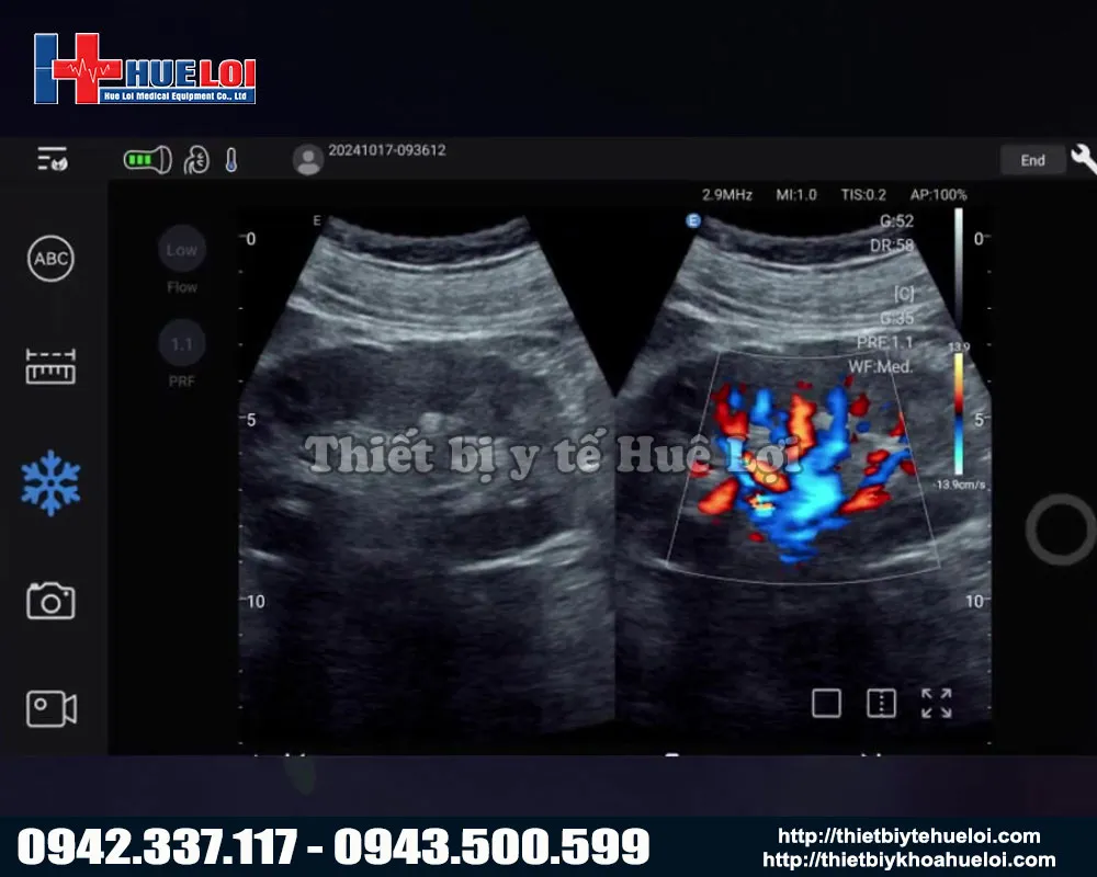 Hình ảnh thực tế sử dụng máy siêu âm edan nano c5 exp