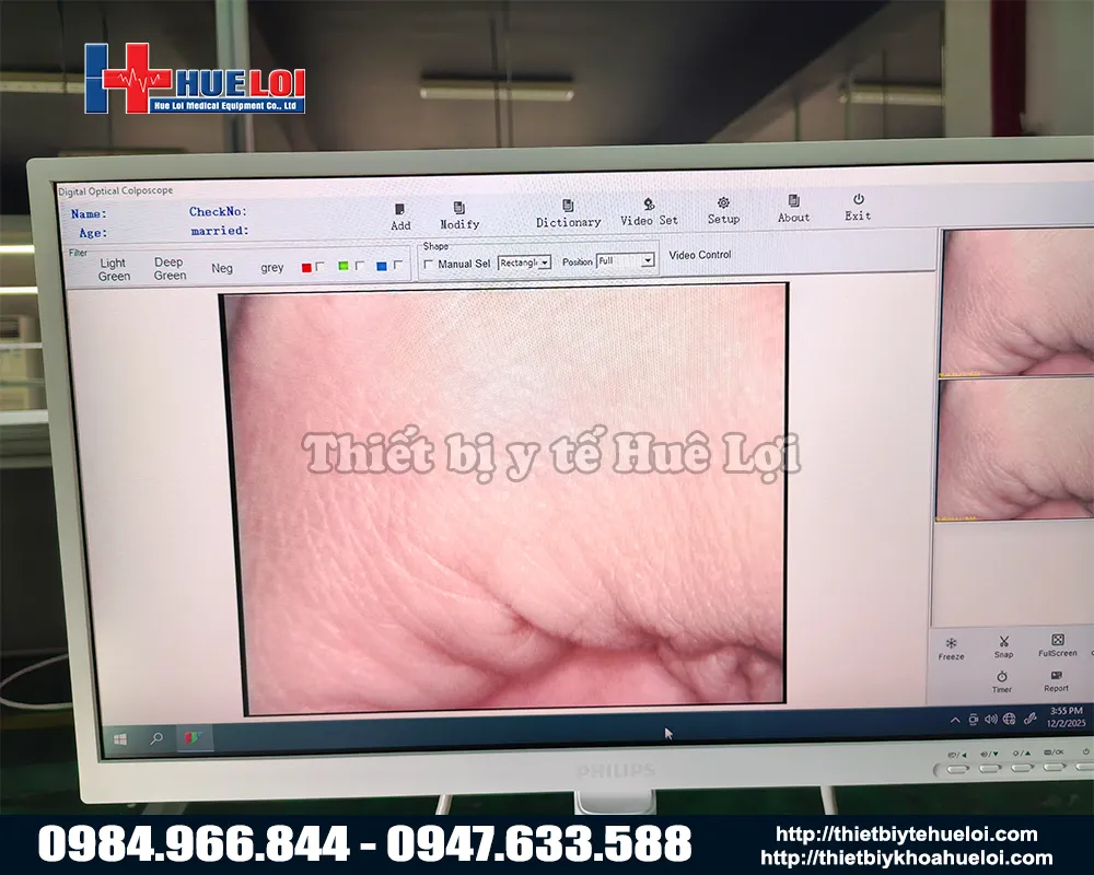 Hình ảnh từ máy soi cổ tử cung full hd sw304