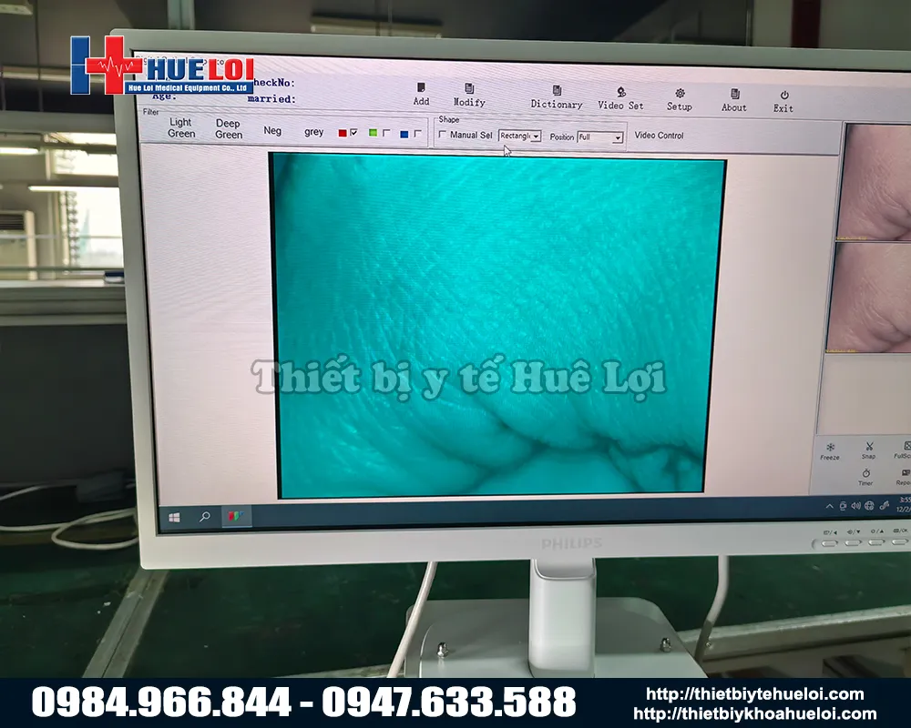 Hình ảnh từ máy soi cổ tử cung full hd sw304