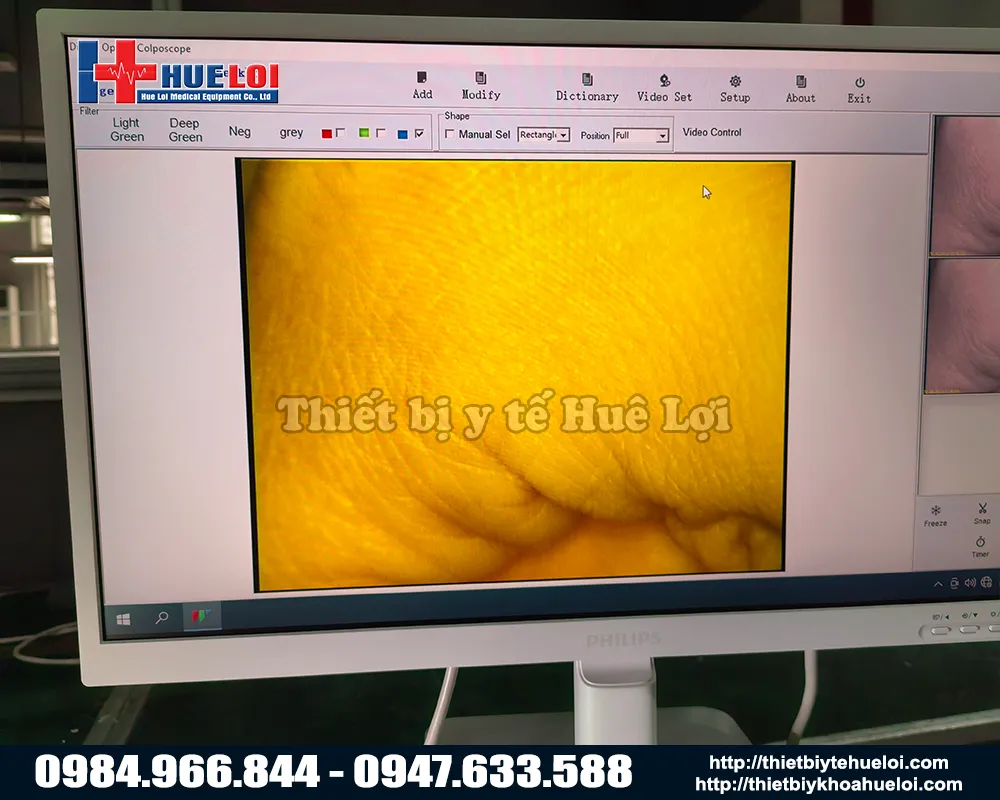 Hình ảnh từ máy soi cổ tử cung full hd sw304